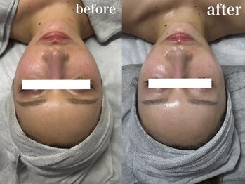 ナチュールムーン(Nature moon.)/ハーブピーリング