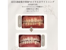 プラスビーセルフ(+b self)/ホワイトニングビフォーアフター