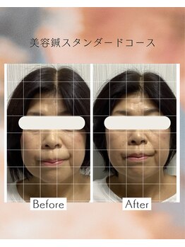 サロン ド ハリッシュ(Salon de HARISH)/初めての美容鍼でお顔スッキリ◎