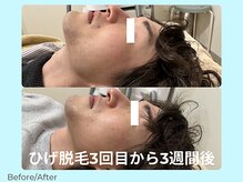 ワンズライフ(ONE‘S LIFE)/Before/After【ひげ3回目】