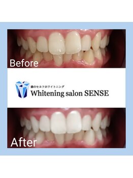 センス(SENSE)/Before＆Aｆter　ホワイトニング