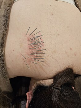 はりきゅう和 ルート鍼灸院/肩甲骨の内側の痛み