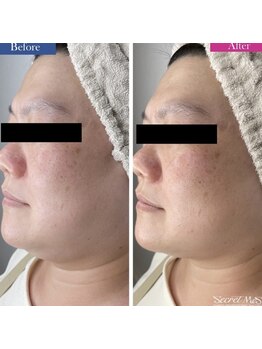 ユフラ(Juhla)/【切らない小顔リフト】