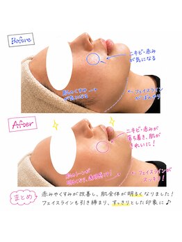 ロバスト(ROBUST)/【セラピール】【艶肌】