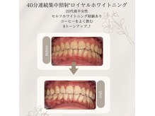 プラスビーセルフ(+b self)/ホワイトニングビフォーアフター