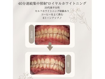 プラスビーセルフ(+b self)/ホワイトニングビフォーアフター