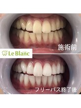 ルブラン 奈良店(Le Blanc)/歯茎も引き締まって見える！