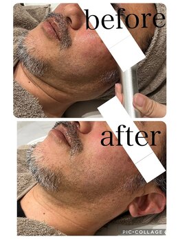 ランソ ビューティー 成田(RUNSO Beauty)/高周波×マイクロカレントで小顔