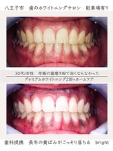 ブライト 八王子(bright)/30代女性/八王子ホワイトニング