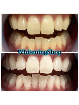 ホワイトニングショップ 山形店(Whiteningshop)/用事がてらにホワイトニング