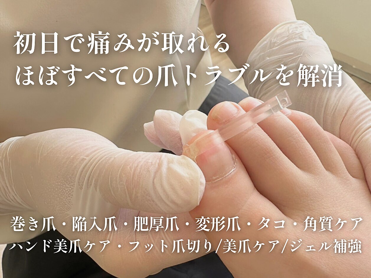 yhma様 専用ペディグラス ビックフォースタイル巻き爪ケア