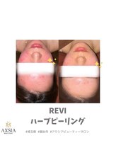 アクシア ビューティー サロン(AXSIA)/【ハーブピーリング】