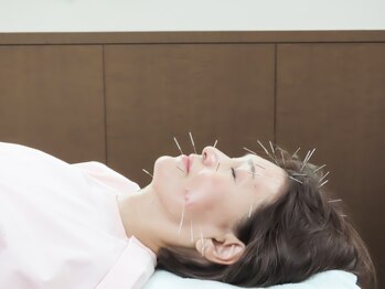 鍼灸チェリーハンドの写真/【目元の小じわ改善/ほうれい線ケアに】セルフケアの難しい、細かい/深いしわに美容鍼灸で徹底アプローチ★