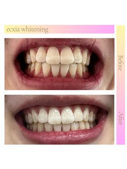 エクシアホワイトニング 倉敷店/ホワイトニングビフォーアフター