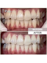 イージーホワイトニング 神戸三宮店(easy whitening)/お客様の症例写真です★