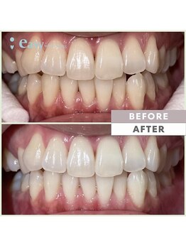 イージーホワイトニング 神戸三宮店(easy whitening)/お客様の症例写真です★