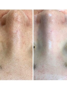 クラウドナイン(CLOUD NINE)/ビフォアアフター(毛穴洗浄)