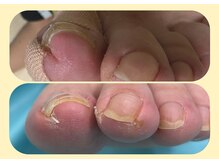 イルミナ(illumina)の雰囲気（皮膚への食い込みを解放！施術当日から普段通りの生活が可能）