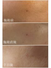 ヴィアージュ(Viage)/シミケア