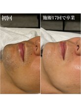 ルシャトン(Le Chaton)/ヒゲ脱毛