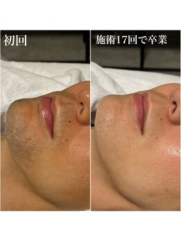 ルシャトン(Le Chaton)/ヒゲ脱毛