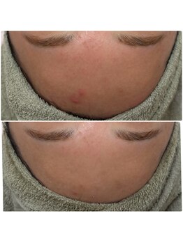 プリマプリート 可児店/ニキビケア