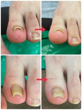 名古屋駅前巻き爪センター/巻き爪