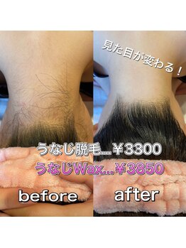 フルウム(FULVUM)/うなじ光脱毛