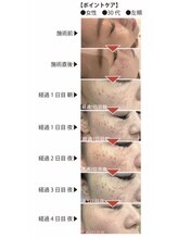 ソウ 新宿(SOU)/効果大のシミケア美白施術☆