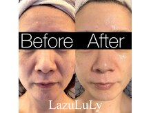 ラズリ(LazuLuLy)の雰囲気（５回の結果！効果を実感できるケアで、あなたのお悩み解消します）