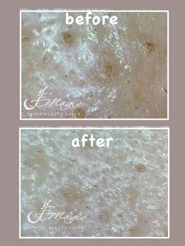 ビーマジック(美magic)/ハイドラ肌質改善