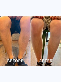 ビークリア(B.clear)/メンズ全身脱毛（顔＋VIO込）