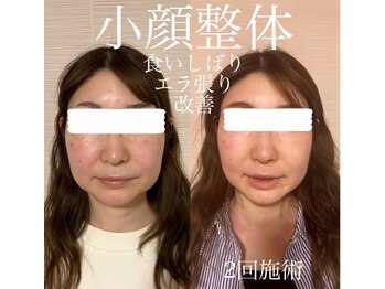 エクレクティック(ECLECTIC)/エラ張り改善/小顔整体