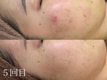 ホワイトアクア 京都店(WHITE AQUA)/ハーブピーリング/毛穴/京都