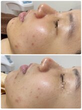 エムケーサロン(MK salon)/クレンジングと洗顔を変えました