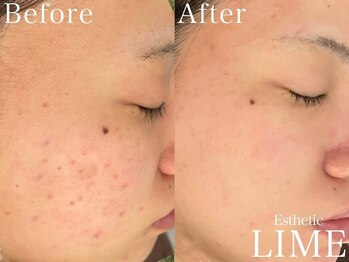 ベル 後楽園 春日(Belle)/ニキビケア｜毛穴洗浄