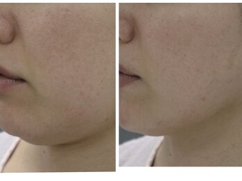 Nビューティー/最新RFサーモシェイプオーパス