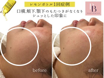 フォトビズ/レモンボトルでたるみ激変！小顔