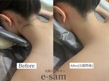 イーサム 高槻摂津富田店(e-sam)/襟足脱毛