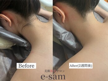 イーサム 高槻摂津富田店(e-sam)/襟足脱毛