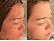 ベル 熊本 水前寺(Belle)の雰囲気（【透明感美肌】ハーブピーリング/韓国式ダーマで陶器肌に）