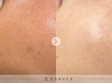 スパレーカ(Spa laka)/赤み・シミケア