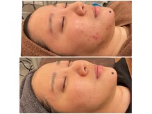 アクトベレッザ(Act BELLEZZA)の雰囲気（最新韓国肌管理　　　肌荒れ・ニキビ・毛穴ケア）