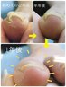 【巻爪】足の巻き爪補正【2本】BSブレイスクイック