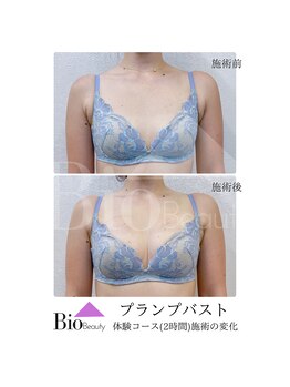 バイオビューティー 神戸本店(Bio Beauty)/プランプバスト　施術症例