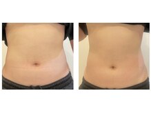 ルナート(Lunart)/学生さんの腸もみ