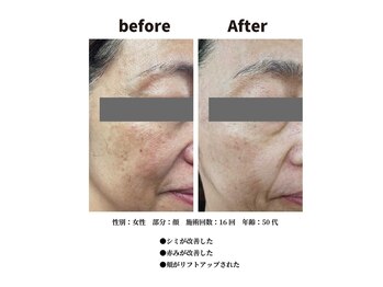 コラソン(CORAZON)/肌のお悩みには光フェイシャル★