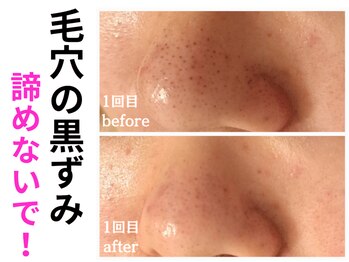 エリン(ERIN)/毛穴徹底洗浄　１回目