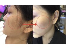 モガナ(mogana)/炭酸パックでWアプローチ