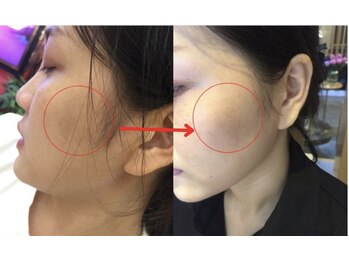 モガナ(mogana)/炭酸パックでWアプローチ